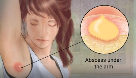 What an abscess looks like. 
