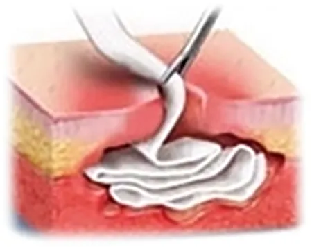 Applying medical dressing to wound