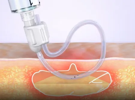 Close-up of medical tubing and skin